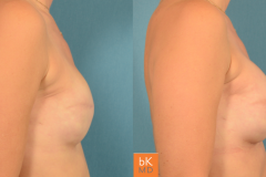Breast Reconstruction Revision