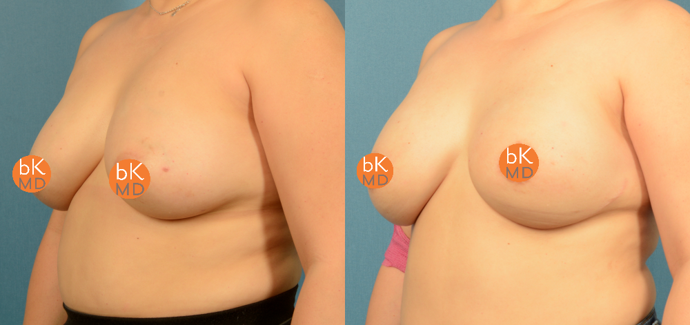 2 Stage Bilateral Breast Reconstruction