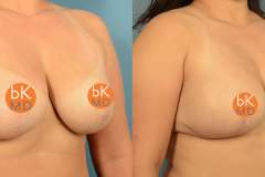2 Stage Bilateral Breast Reconstruction