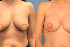 3 Stage Bilateral Breast Reconstruction