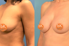 3 Stage Bilateral Breast Reconstruction