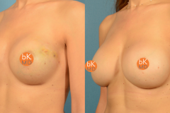 4 Stage Bilateral Breast Reconstruction