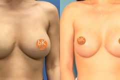 2 Stage Breast Reconstruction