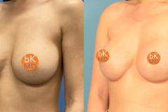 2 Stage Breast Reconstruction